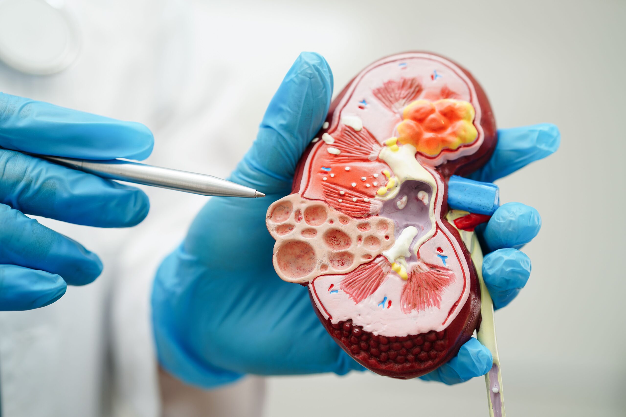FDA approves Tenapanor for chronic kidney disease